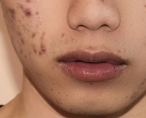 Trị Sẹo Thâm Tại Sen Beauty